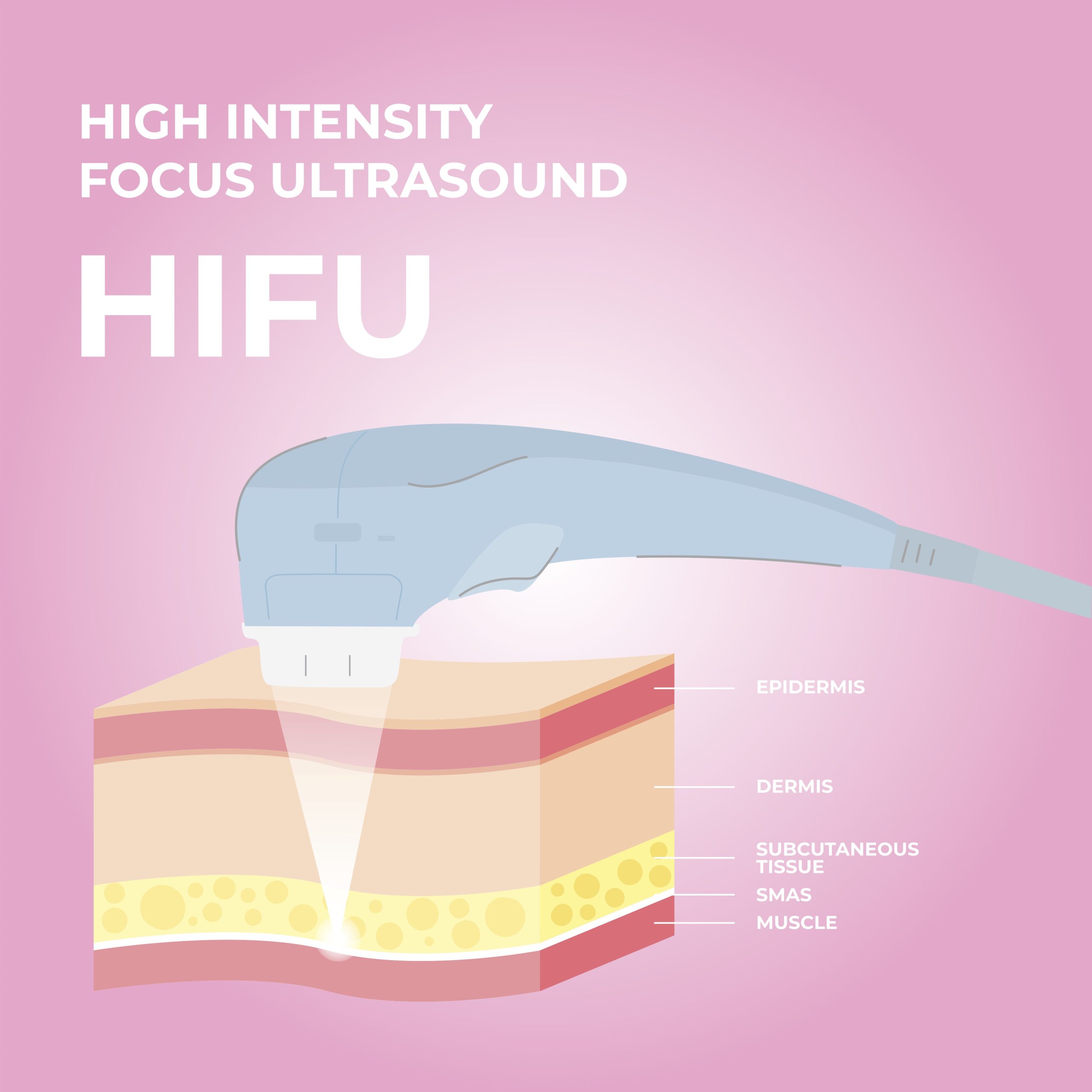 HIFU Treatments in Kings Langley